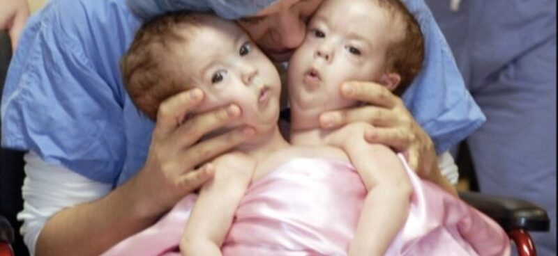 Il Y A Dix Ans Ces Jumeaux Siamois Ont t S par s Gr ce Une il-y-a-dix-ans-ces-jumeaux-siamois-ont-t-s-par-s-gr-ce-une